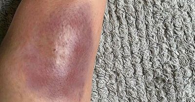 Mum's horrifying injuries after bite from Ireland and the UK's most venomous spider