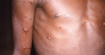 Monkeypox outbreaks in Europe linked to fetish festival and sauna superspreader event