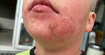 Mum's warning as son, 4, breaks out in severe rash all over his body after touching caterpillar