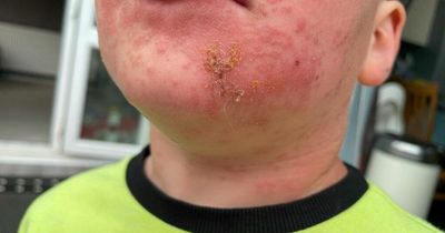 Mum's stark warning as son, 4, breaks out in face rash after touching caterpillar