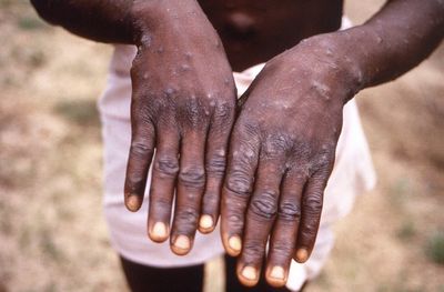 New monkeypox guidance tells high-risk close contacts to isolate for 21 days