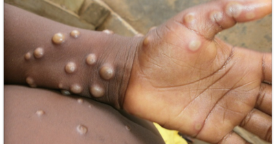 Monkeypox: UK Health Security Agency issues new advice ahead of cases update