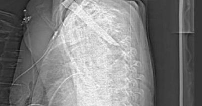 Shocking X-ray shows five-inch knife lodged in base of man's neck