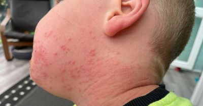 Mum issues warning to others after young son left with rash