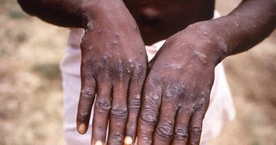 First monkeypox signs and will there be a lockdown as high-risk people advised to isolate