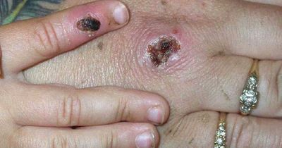 Monkeypox symptoms as PHA says no confirmed cases in Northern Ireland