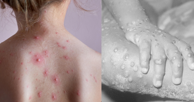 How to tell the difference between monkeypox and chickenpox in a child