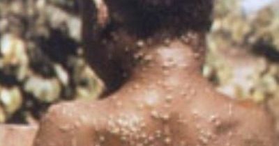 Monkeypox confirmed cases rising as health officials speak out on 'concerning' outbreak