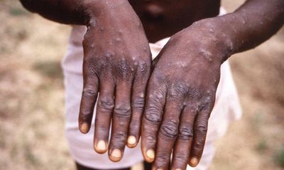 Monkeypox outbreak was waiting to happen, say scientists
