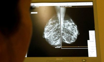 Women in England with breast cancer may qualify for drug that buys ‘precious’ time