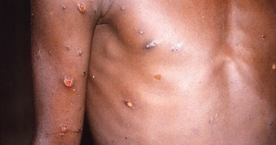 Severe monkeypox patients could be infectious for up to 10 WEEKS, scientists warn