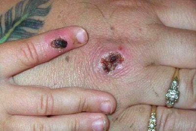 Monkeypox patients can be contagious for up to ten weeks - study
