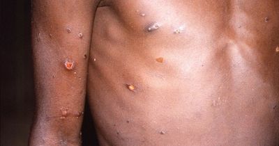 Monkeypox cases up by seven as study warns virus remains infectious after scabs heal