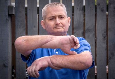 ‘A new lease of life’: British man receives ‘world’s first’ double hand transplant