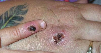 Monkeypox: Six ways to tell if your rash is monkeypox or another condition