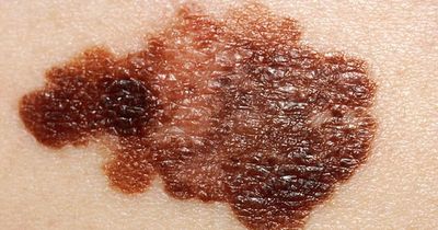 Doctor shares skin cancer 'red flag' signs on moles that could be early melanoma