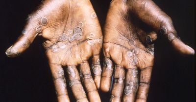 The early symptoms to look out for as first case of monkeypox detected on island of Ireland