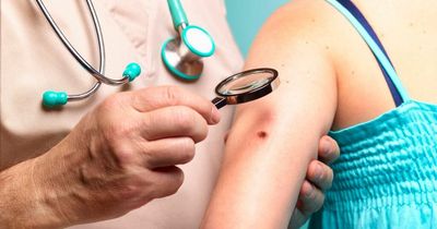 Doctor explains 'red flag' skin cancer signs to watch for on moles