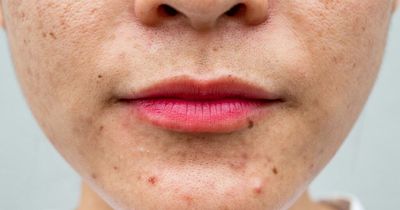 Vitamin B12 deficiency symptoms that show on your face - unusual patches to paleness