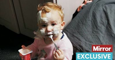 Toddler's horror injuries after 'perfect' family dog tries to rip her face off