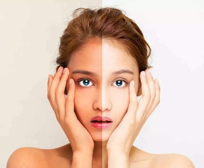 How to deal with sunburn