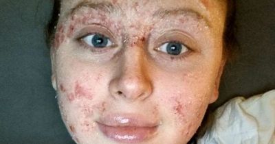 Scots woman hospitalised with chronic eczema gobsmacked by 'miracle' £9 cream that cleared skin overnight