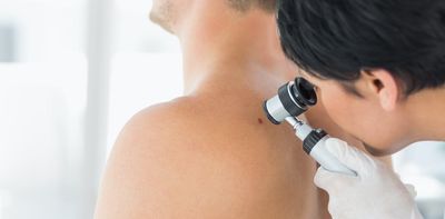 The doctor says my mole is a melanoma. What happens next?