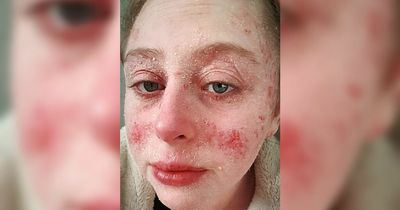 Woman 's excruciating eczema clears overnight thanks to £9 'miracle' cream