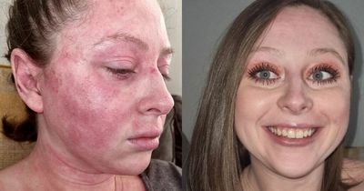 Woman who suffered chronic eczema has life-changing results from 'miracle' £9 cream