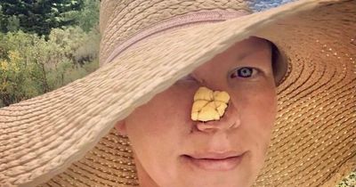 Woman refused to look at herself in mirror after acne scar left her with gaping hole