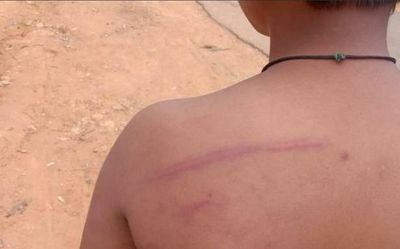 Child returns home with bruises after punishment by teacher in Karnataka