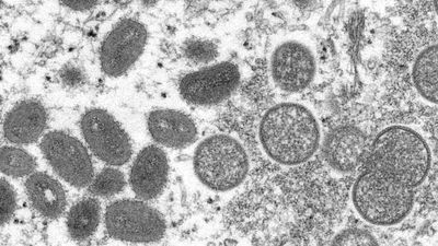 France says 33 monkeypox cases confirmed, no outbreak expected