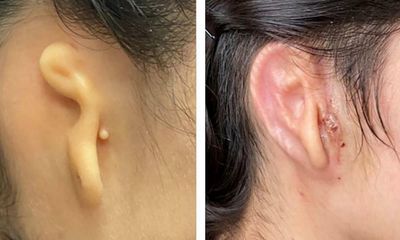 Woman’s ear rebuilt with 3D-printed living tissue implant