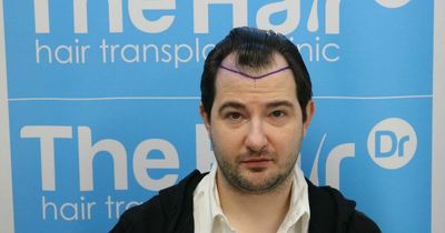 £7.5k hair transplant leaves man 'looking like the Tinder Swindler'
