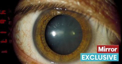 Patients with cataracts forced to wait for a year to get NHS surgery during Covid