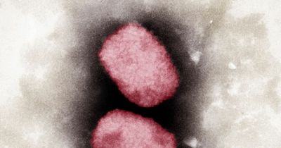 Monkeypox cases in Scotland grow as officials list two reasons to contact doctors
