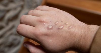 Second case of monkeypox identified in Wales