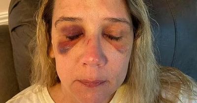 Mum left with broken nose and black eyes after protecting daughter, 16, from gang