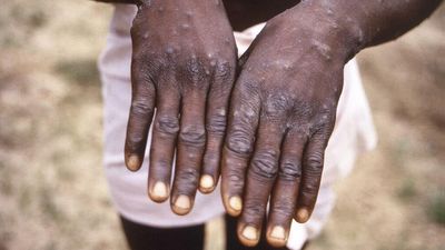 NSW confirms Aust’s sixth monkeypox case