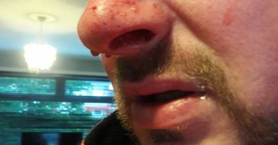 Cyclist covered in blood after incident in 'lawless' street says he 'may never ride again'