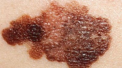 New research finds nearly a third of melanomas found during skin checks may not be harmful, improving treatment options