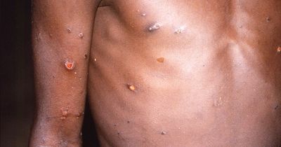 77 more monkeypox cases detected bringing UK total to 302