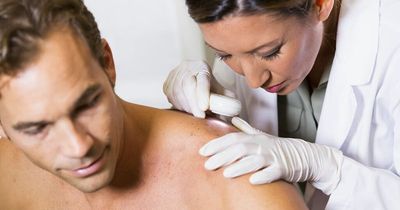 Skin cancer symptoms – mole or blemish change could be first warning sign of cancer