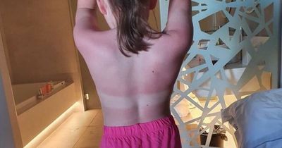 Mum's Spain holiday nightmare as sun cream 'leaves children burnt and hands stained pink'