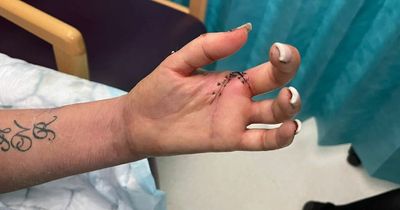 Brit mum-of-seven loses FINGER in horror accident while celebrating 40th birthday