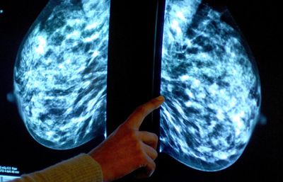 Some breast cancer patients can ‘avoid radiotherapy’ – study