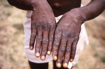 'Very ignorant rumour': Misinformation abounds about monkeypox