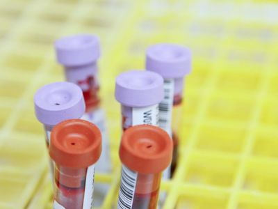 South Africa: Ongoing Clinical Study On Psilocybin For Major Depressive Disorder And HIV-Positive Women