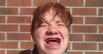 Woman unable to eat for two years as teeth turn black and 'crumble'