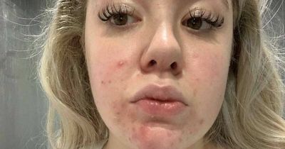 Nurse cures her 'sore red' acne with £18 fake tan